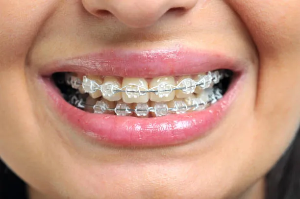 How much do braces cost in Canada?