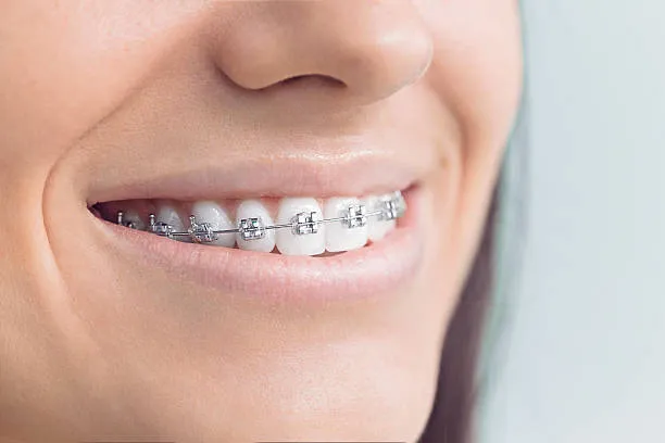 Metallic braces